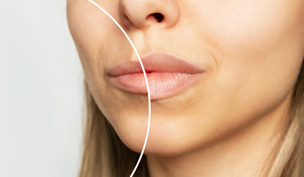 O preenchimento labial é para todos? Existe uma contra indicação.